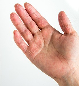 手の甲 湿疹