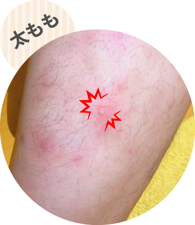 早く治したい痛いおできに効く｜オデキュアEX｜池田模範堂