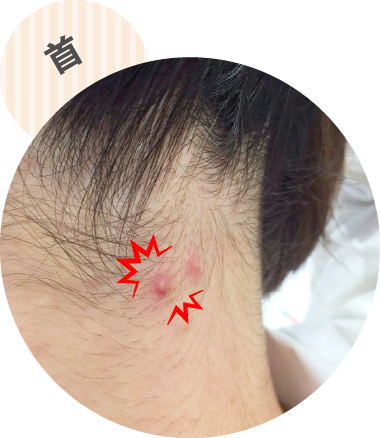 早く治したい痛いおできに効く｜オデキュアEX｜池田模範堂