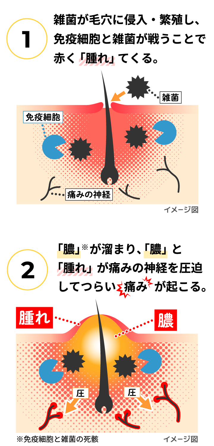 早く治したい痛いおできに効く｜オデキュアEX｜池田模範堂