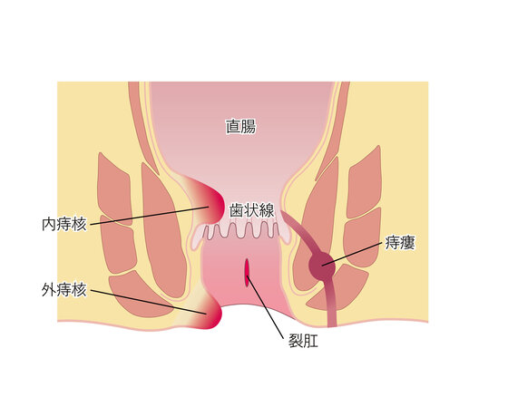 痔の種類のイメージ図